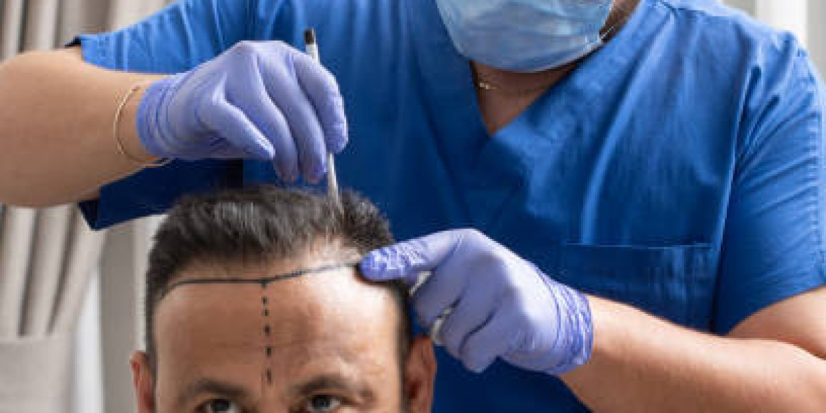 How to Achieve Optimal Results in Hair Restoration